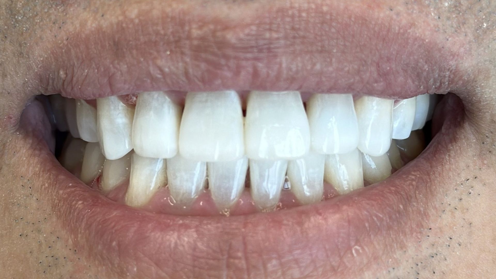 Before and after image of smile