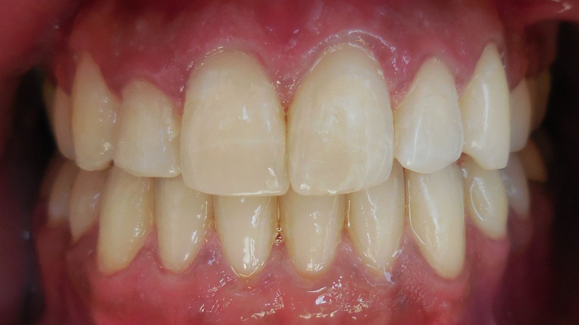 Before and after image of smile