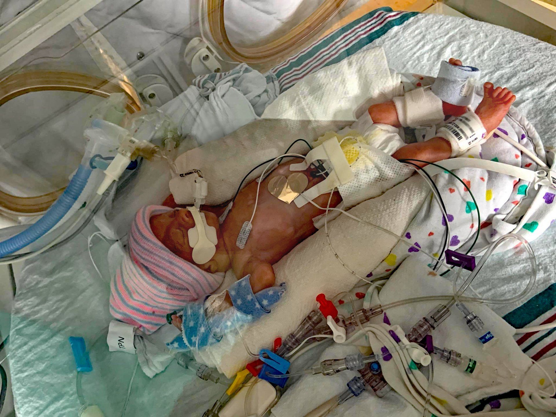 premature infant