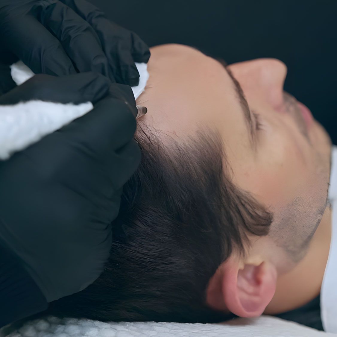 Close-up of a person's head, receiving a hair treatment. Black-gloved hands hold a tool near the hairline.