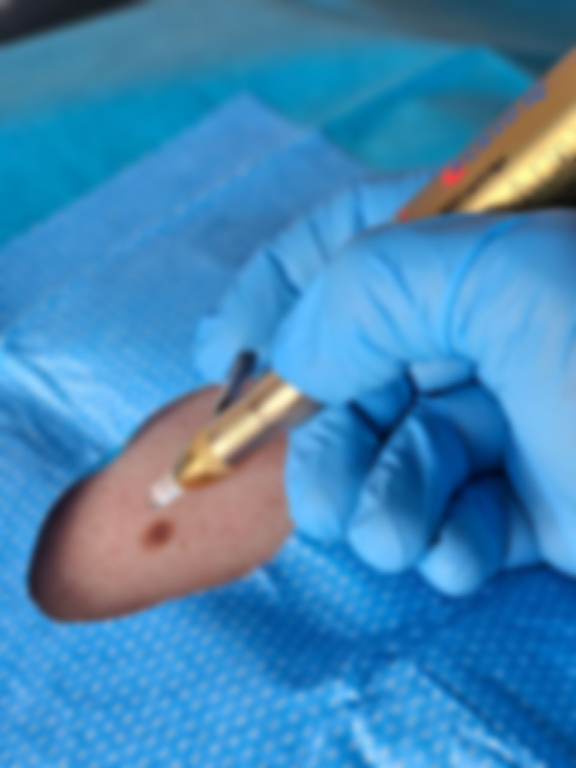 Cryotherapy Skin Lesion Removal