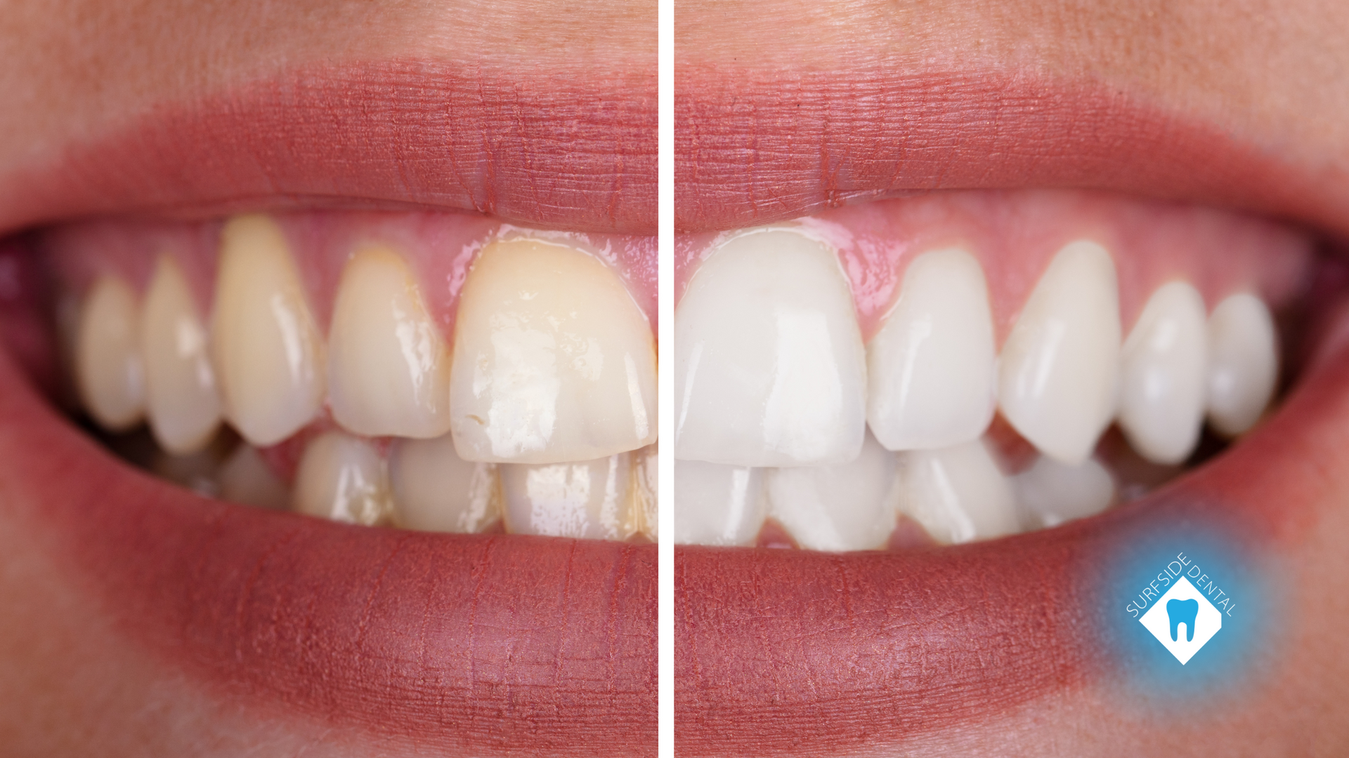 A before and after picture of a woman 's teeth.