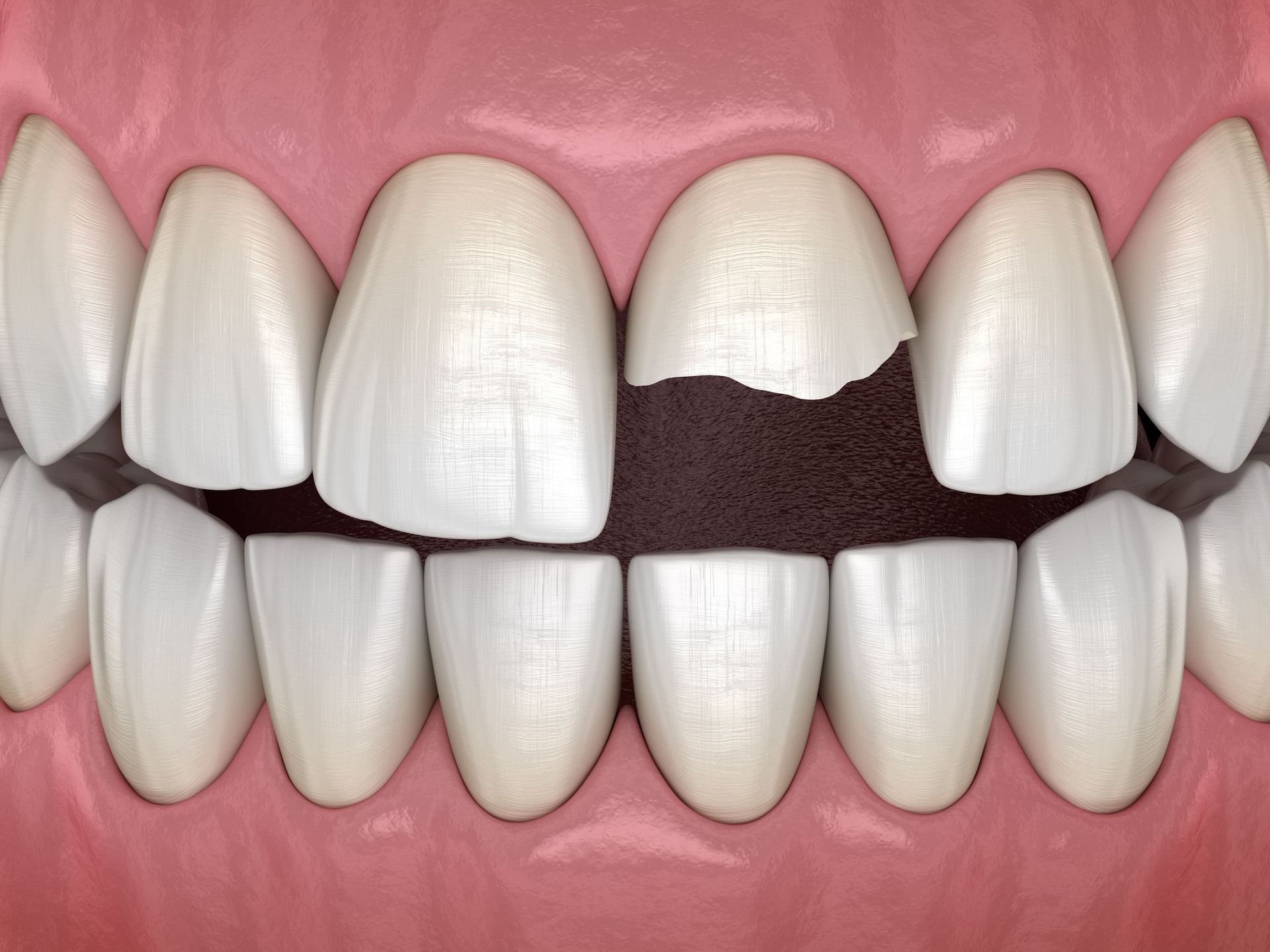 A computer generated image of a chipped tooth