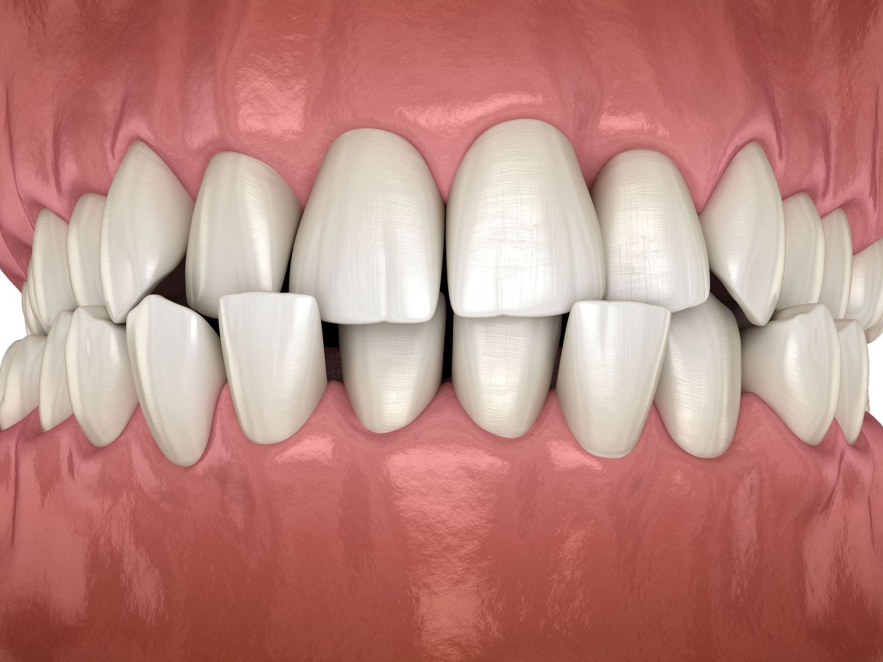 A computer generated image of teeth with a cross bite