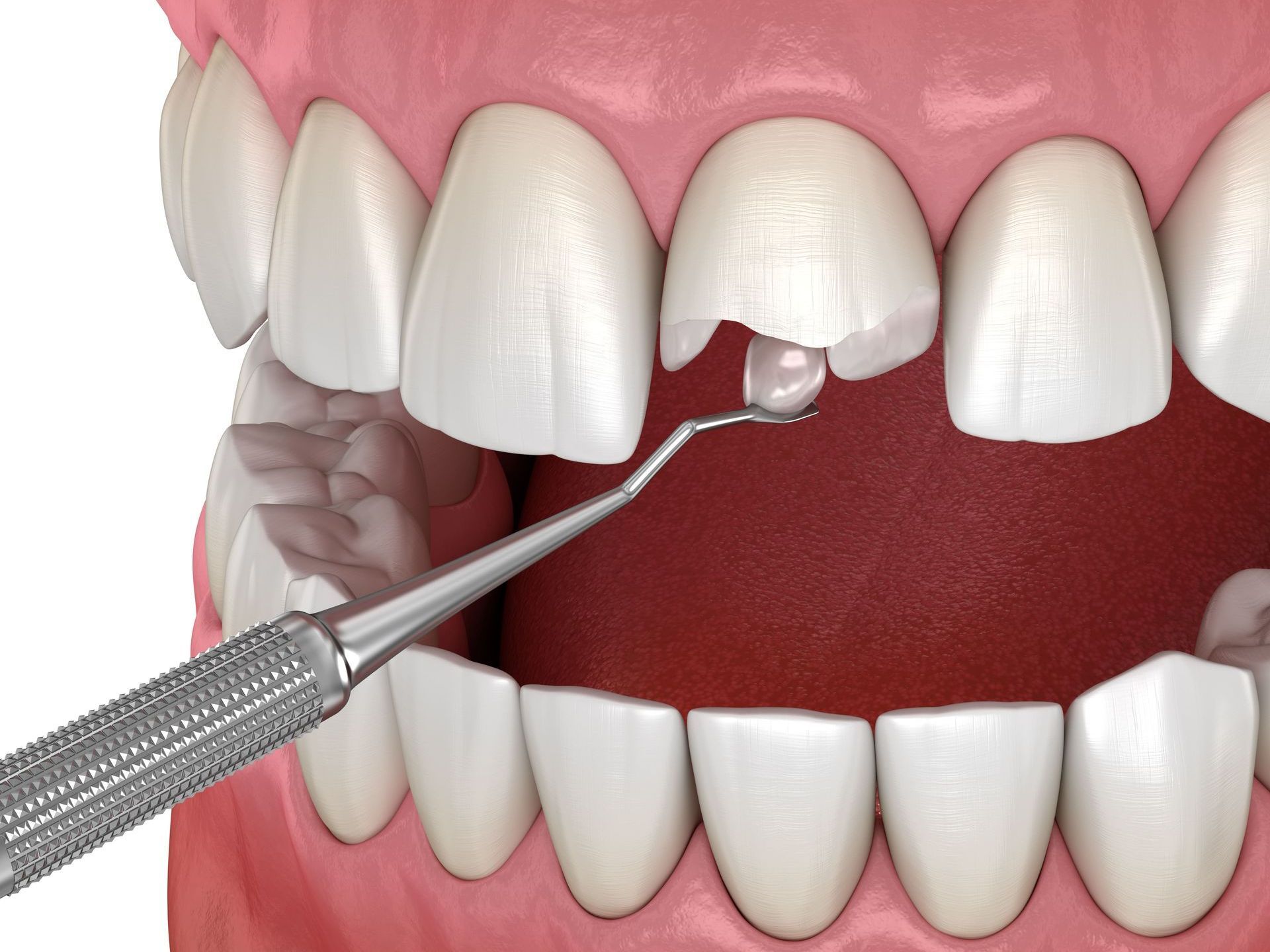 A computer generated image of a chipped tooth being repaired