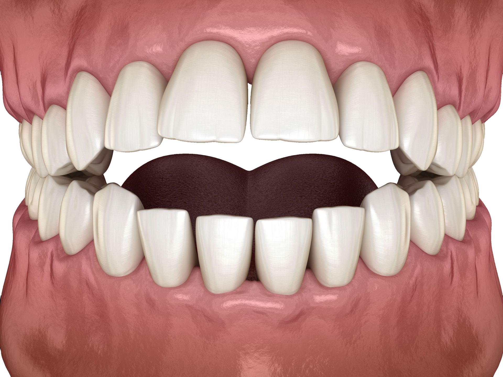 A computer generated image of teeth with an open bite