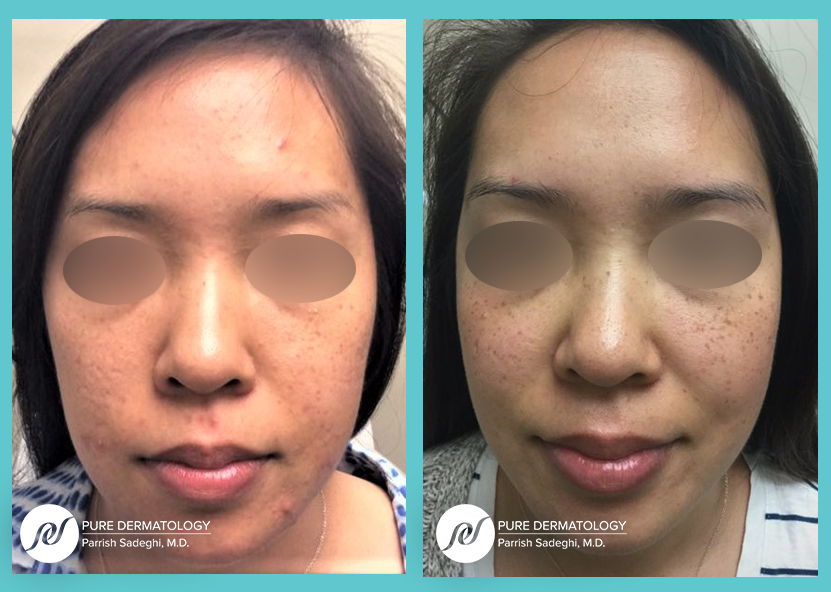 A before and after photo of a woman 's face