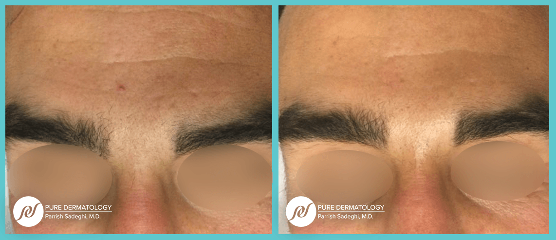 A before and after photo of a man 's forehead.