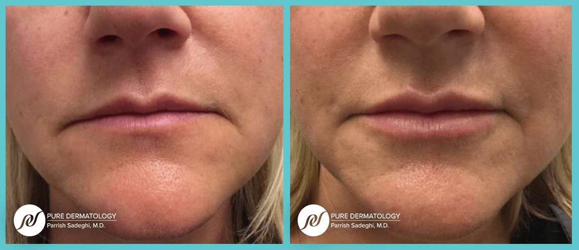 A before and after photo of a woman 's face