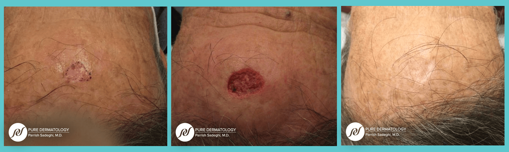 patient before and after Mohs Micrographic Surgery at Pure Dermatology