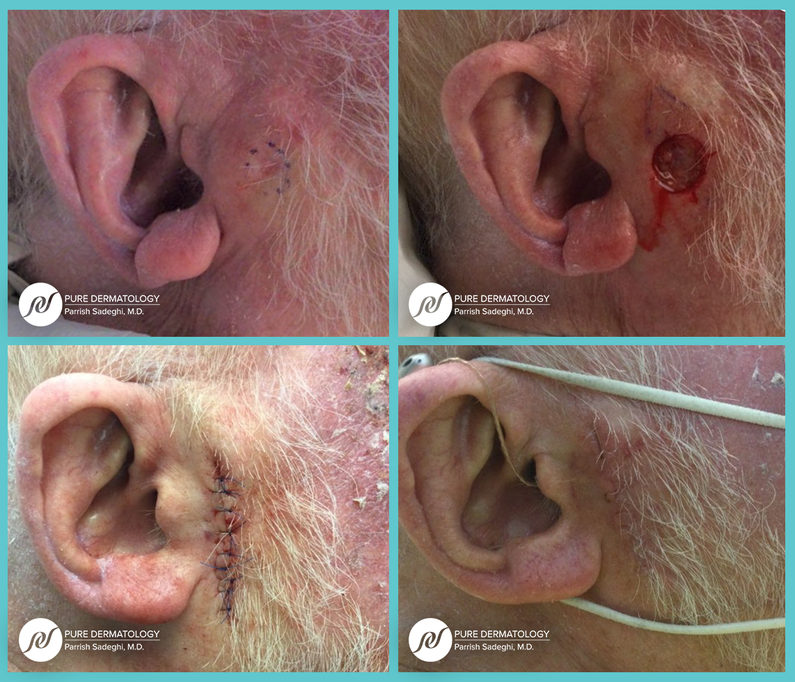 patient before and after Mohs Micrographic Surgery at Pure Dermatology
