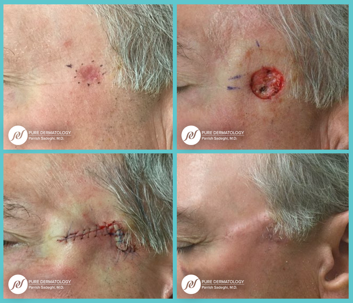patient before and after Mohs Micrographic Surgery at Pure Dermatology