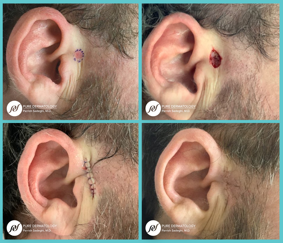 patient before and after Mohs Micrographic Surgery at Pure Dermatology