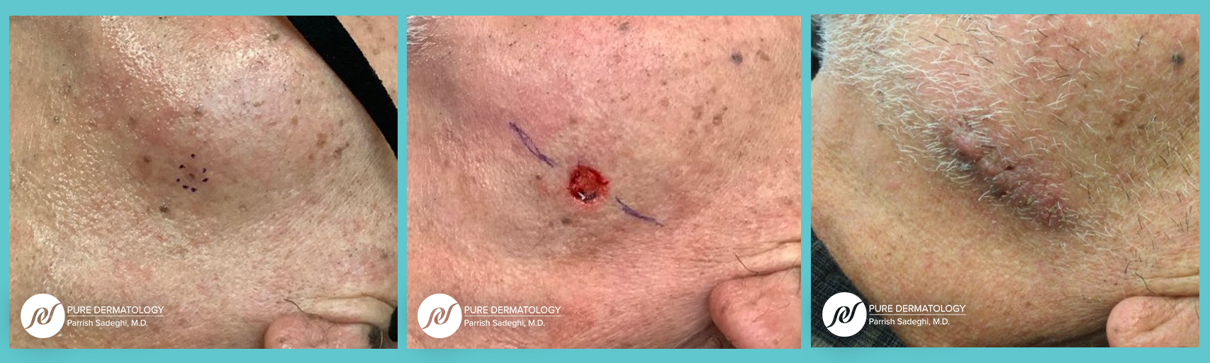 patient before and after Mohs Micrographic Surgery at Pure Dermatology