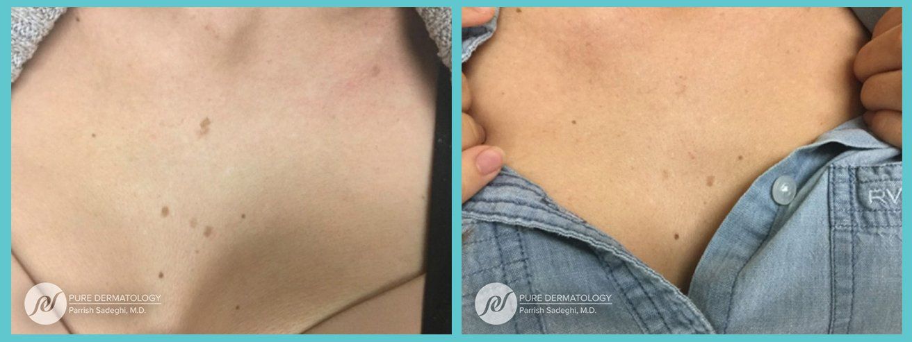 A before and after photo of a person 's chest