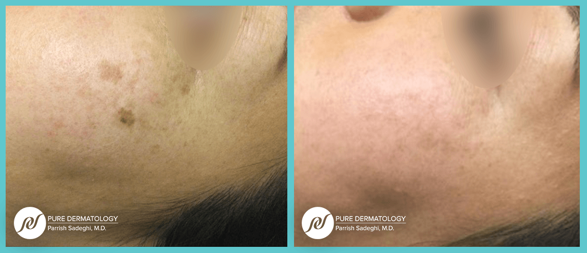 A before and after photo of a woman 's face