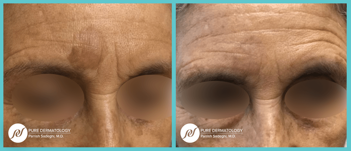 A before and after photo of a woman 's forehead