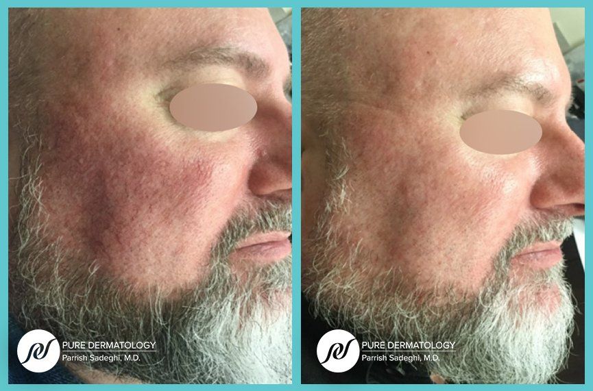 A man with a beard has a before and after photo of his face.
