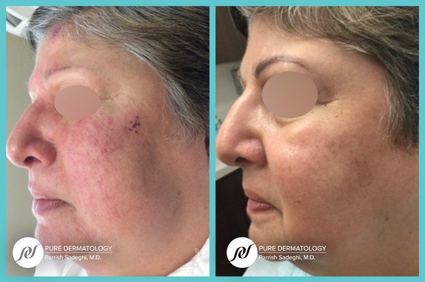 A before and after photo of a woman 's face.