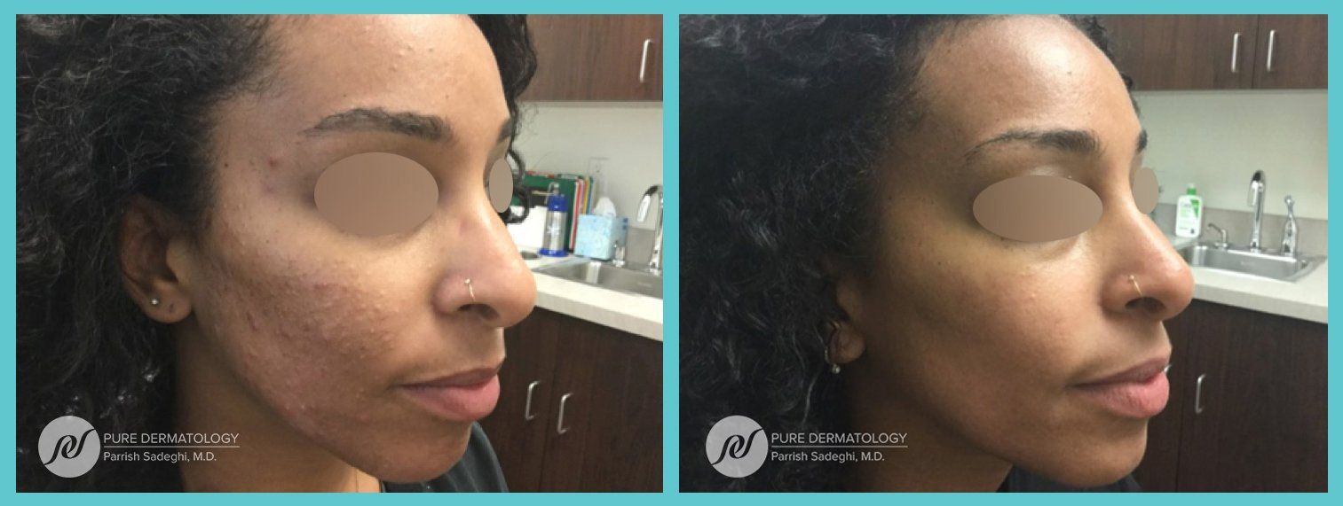 patient before and after Acne treatment at Pure Dermatology