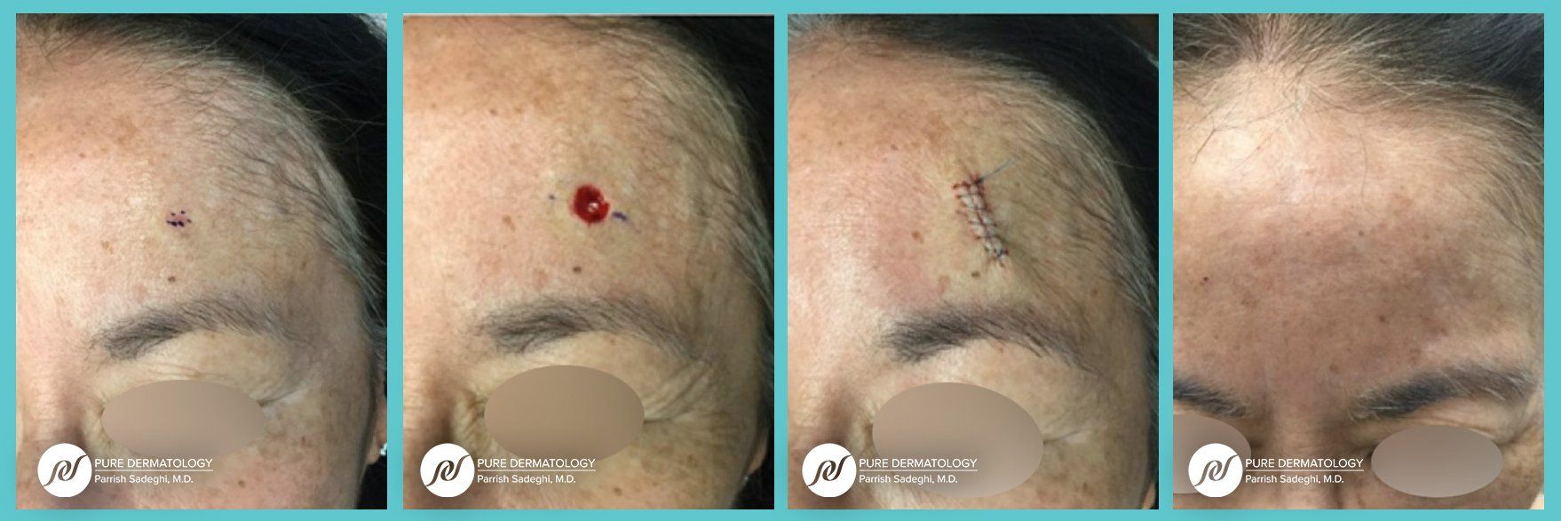 patient before and after Mohs Micrographic Surgery at Pure Dermatology