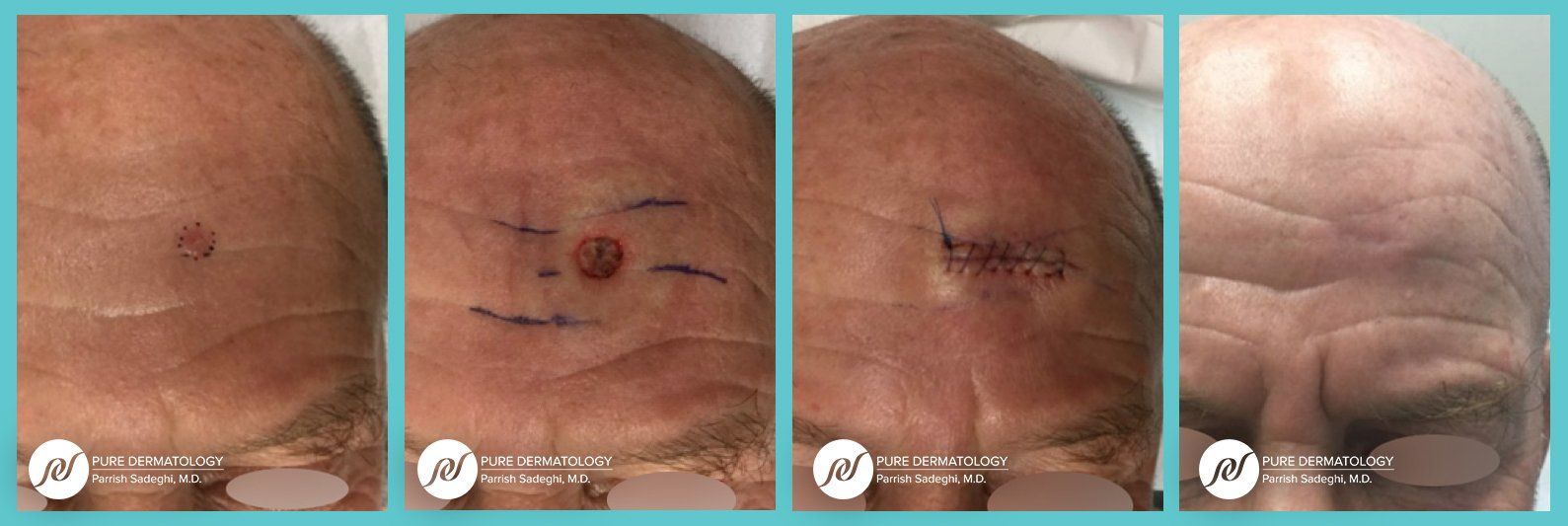 patient before and after Mohs Micrographic Surgery at Pure Dermatology