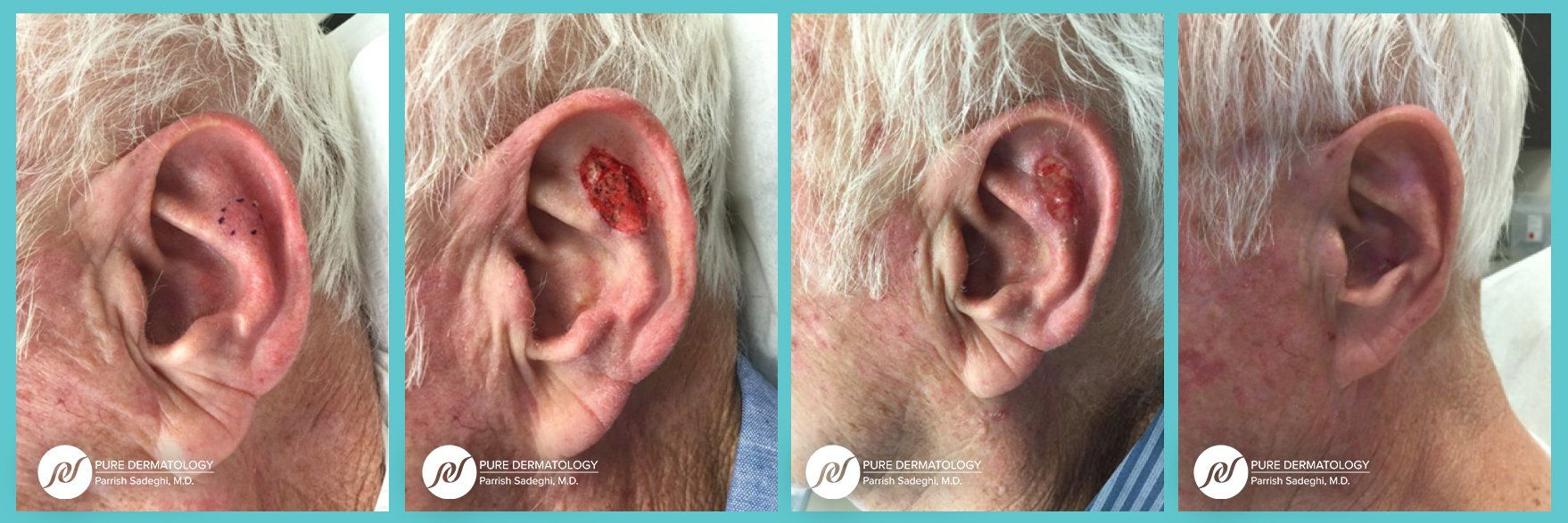 patient before and after Mohs Micrographic Surgery at Pure Dermatology