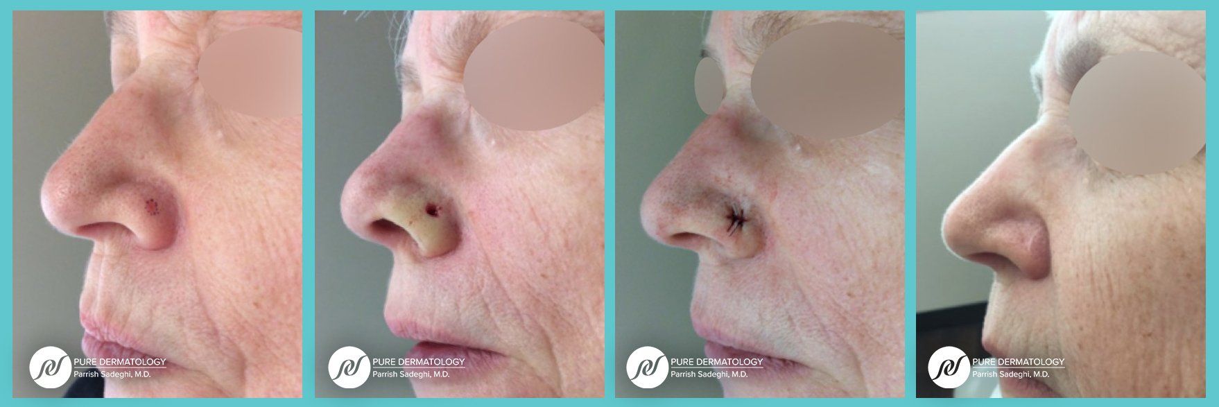 patient before and after Mohs Micrographic Surgery at Pure Dermatology