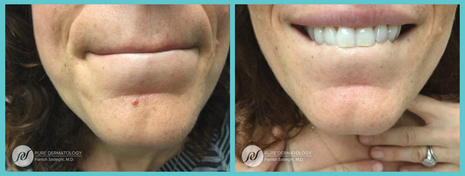 A before and after photo of a woman 's face