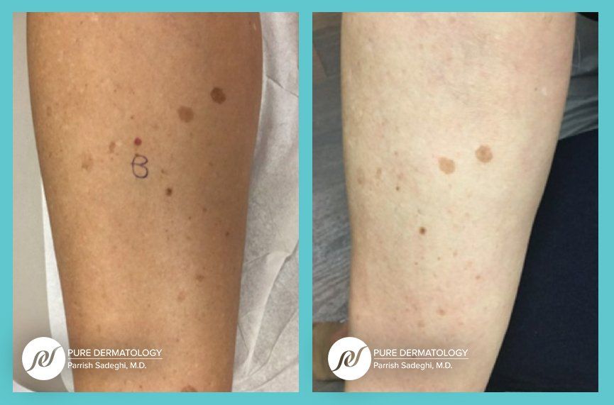 A before and after photo of a person 's leg with spots on it.