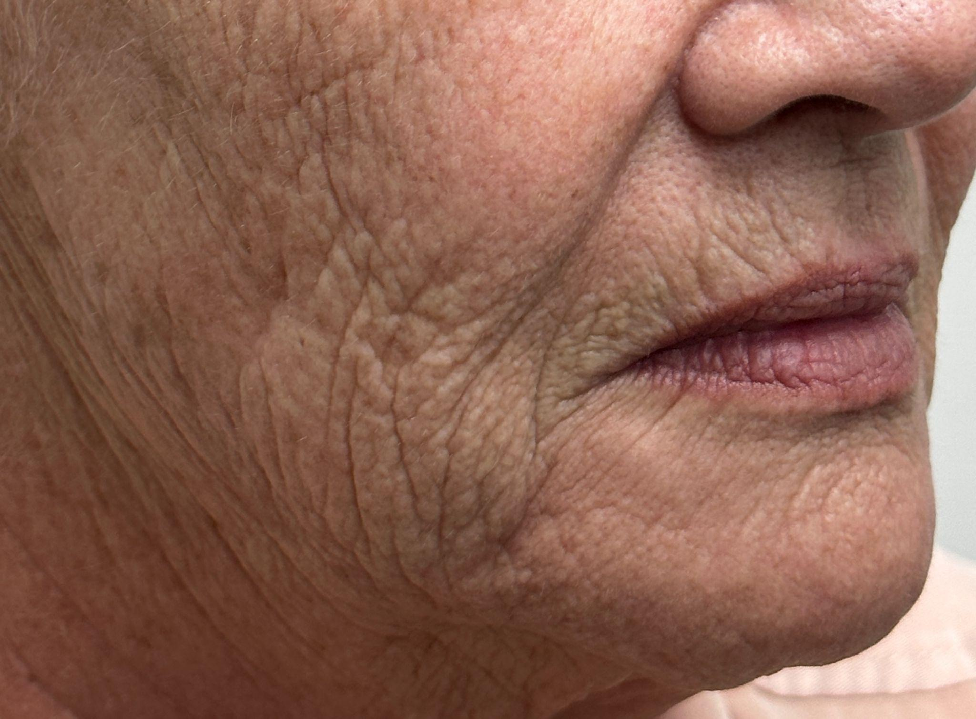 Close-up view of the lower half of a face showing natural skin texture, including visible fine lines and wrinkles.