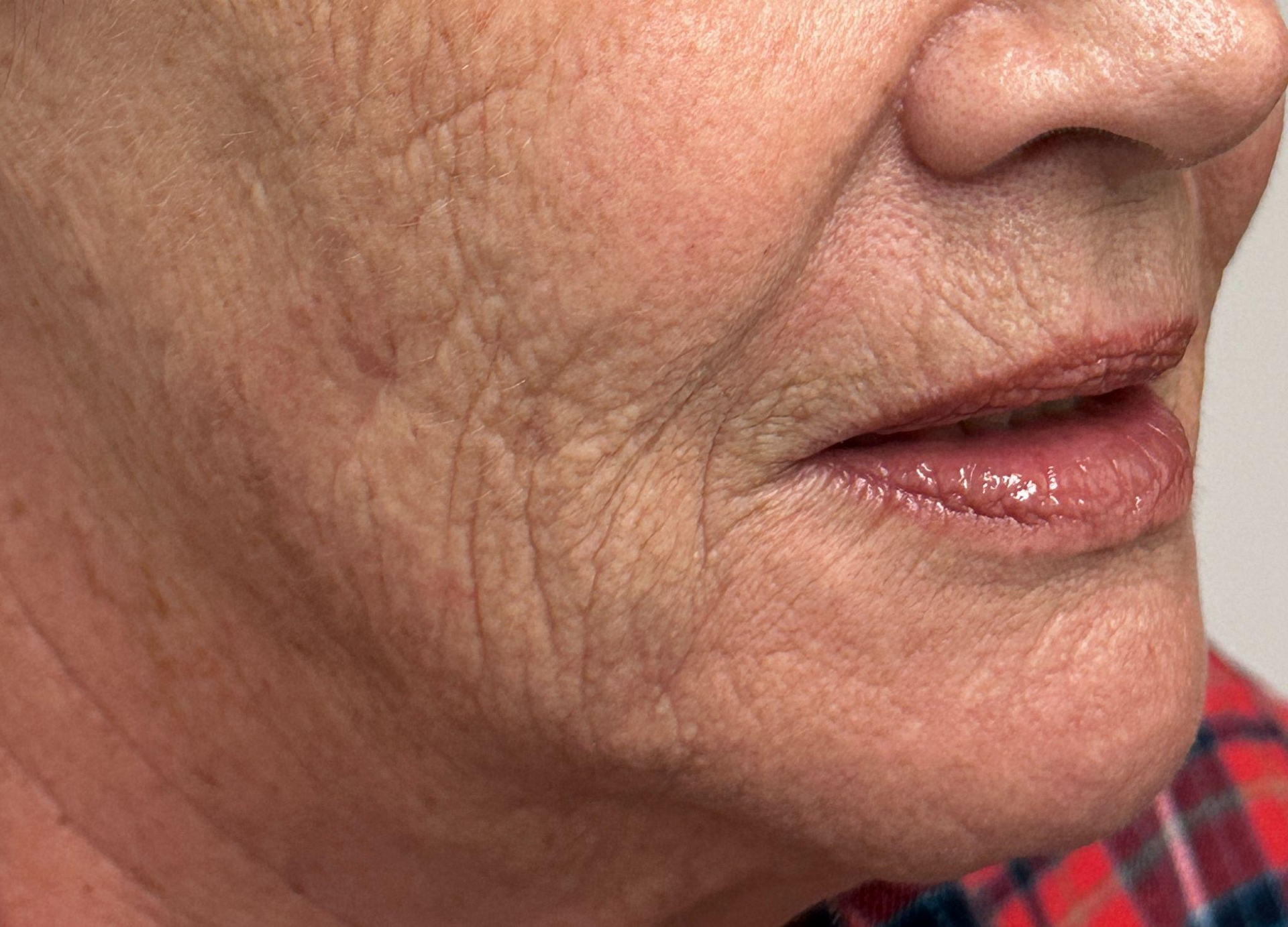 A close-up view of the lower face, showing skin texture, fine lines, and wrinkles around the cheek and mouth area.