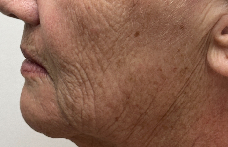 Close-up of a person's side profile showing skin texture, wrinkles, and sunspots on the cheek, jawline, and neck.