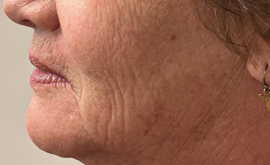 Side profile of a person's lower face showing visible skin texture, fine lines, and moderate wrinkles.