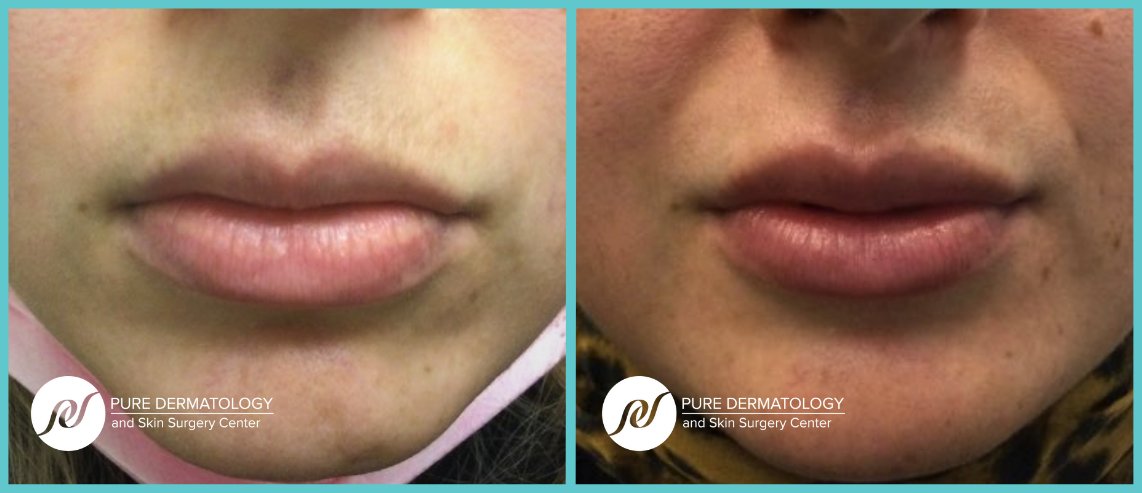 A before and after photo of a woman 's lips with the letter n on the bottom