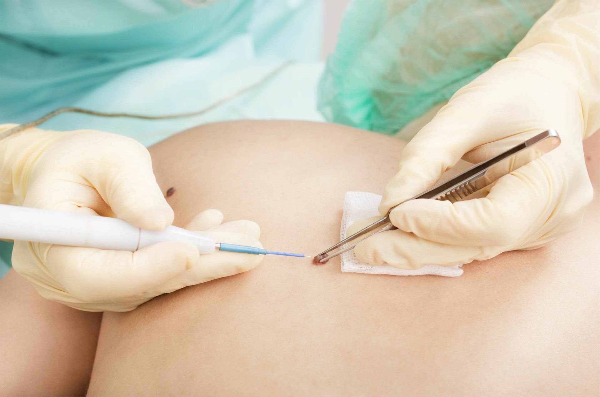 dermatologist removing mole