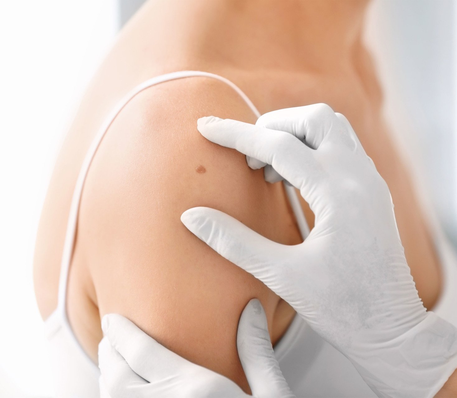 doctor examining mole on young woman