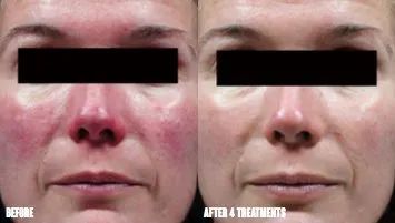 Before and after comparison of a person's face showing a significant reduction in facial redness after four treatments.