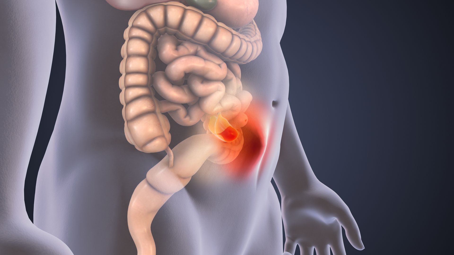 Ilustração médica da parte inferior do abdômen com destaque para a dor vermelha próxima ao cólon.