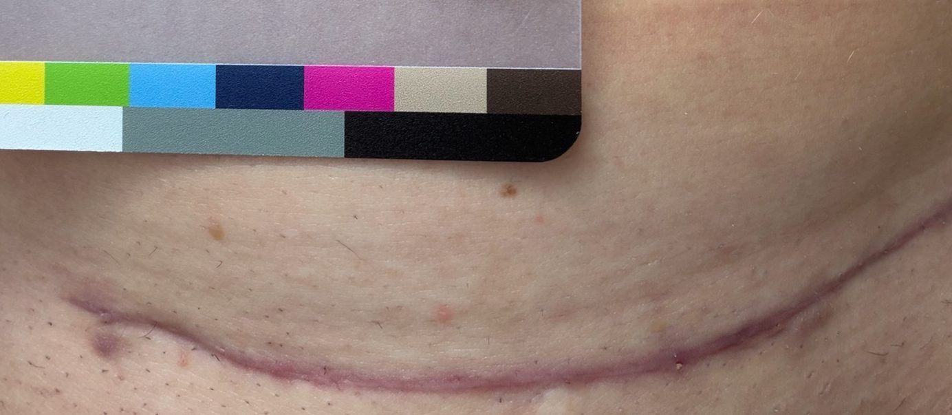 Participant photo, baseline, June 29, 2026: lower abdomen with a horizontal C-section scar below the MRJP1 color card.