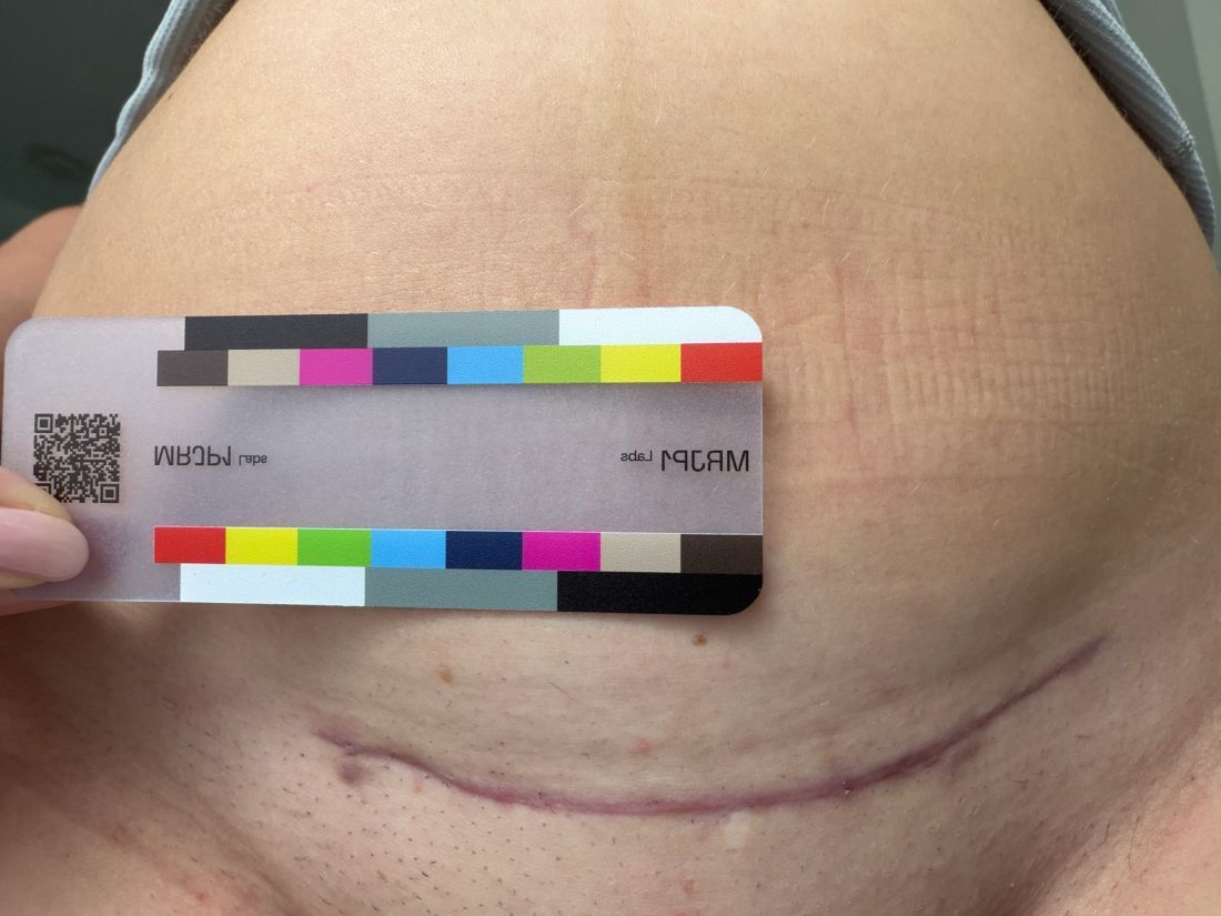 Original baseline photo as taken, June 29, 2026: lower abdomen with a horizontal C-section scar below the MRJP1 color card.