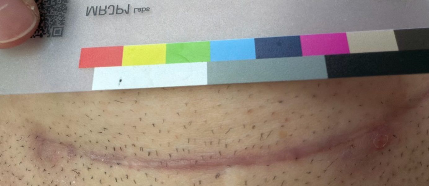 Participant photo, day 77, September 14, 2026: the same scar.