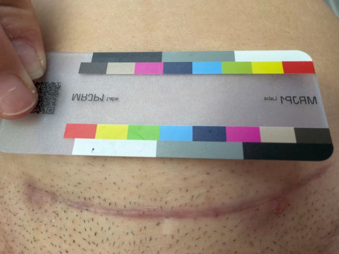 Original day 77 photo as taken, September 14, 2026: the same scar.
