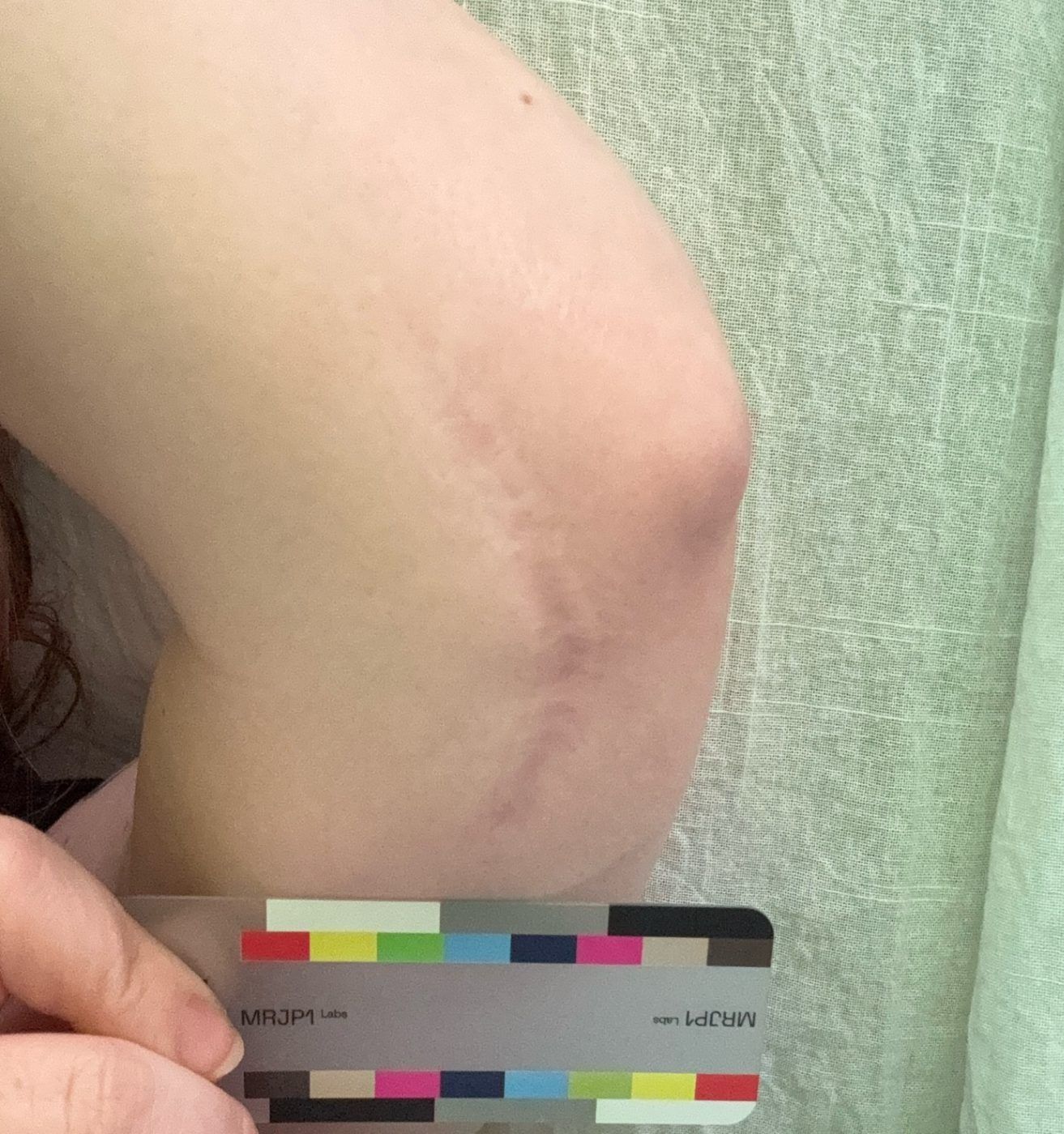 Participant photo, baseline, June 15, 2026: raised arm with a vertical surgical scar near the elbow and the MRJP1 color card.