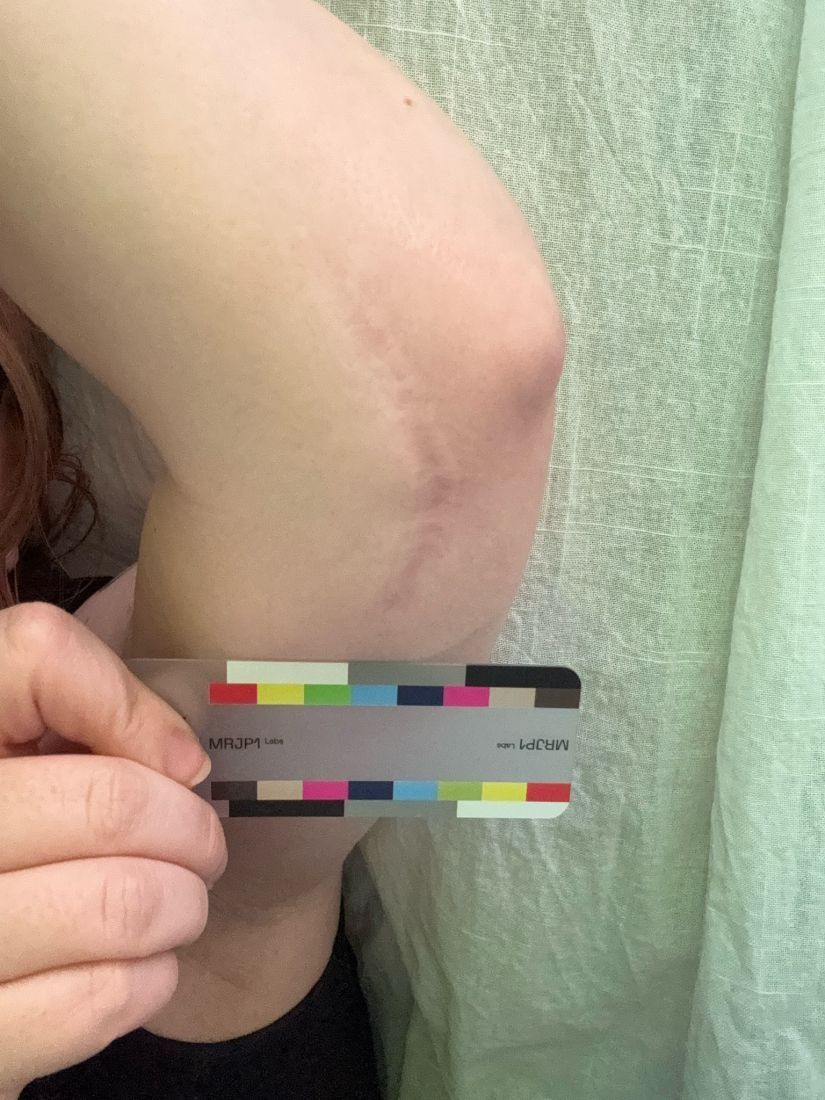 Original baseline photo as taken, June 15, 2026: raised arm with a vertical surgical scar near the elbow and the MRJP1 color card.