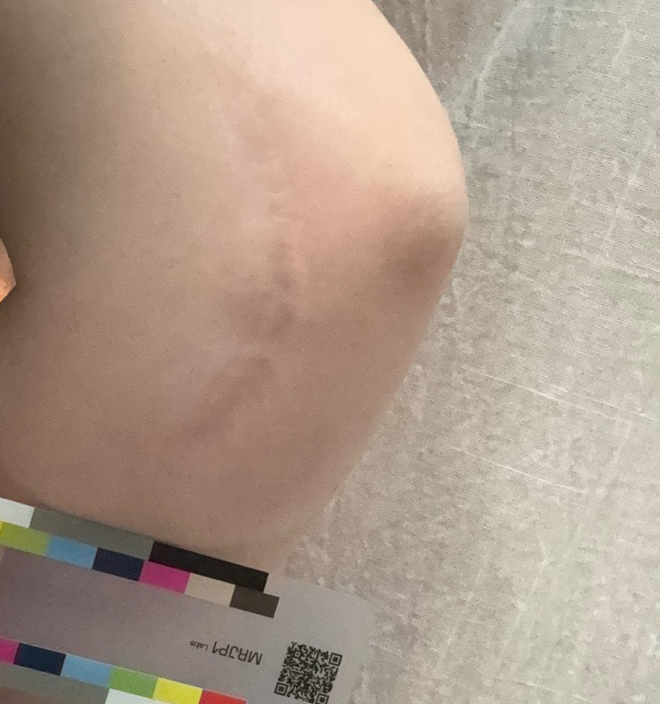 Participant photo, day 78, September 1, 2026: the same scar.