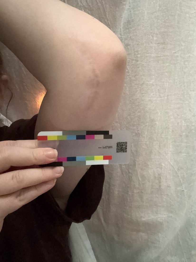 Original day 78 photo as taken, September 1, 2026: the same scar.
