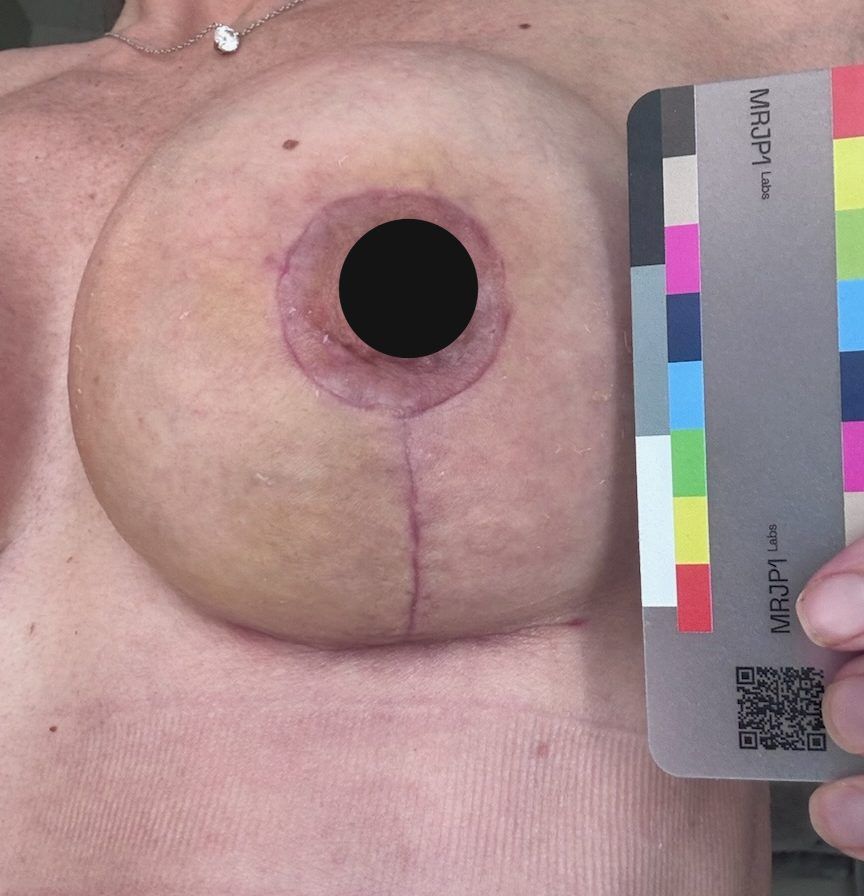 Participant photo, baseline, June 18, 2026: breast with a vertical surgical scar running down from the areola and the MRJP1 color card. The nipple is covered with a black circle for privacy.
