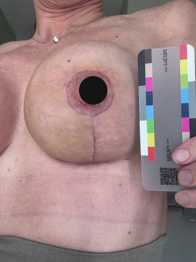 Original baseline photo as taken, June 18, 2026: breast with a vertical surgical scar running down from the areola and the MRJP1 color card. The nipple is covered with a black circle for privacy.