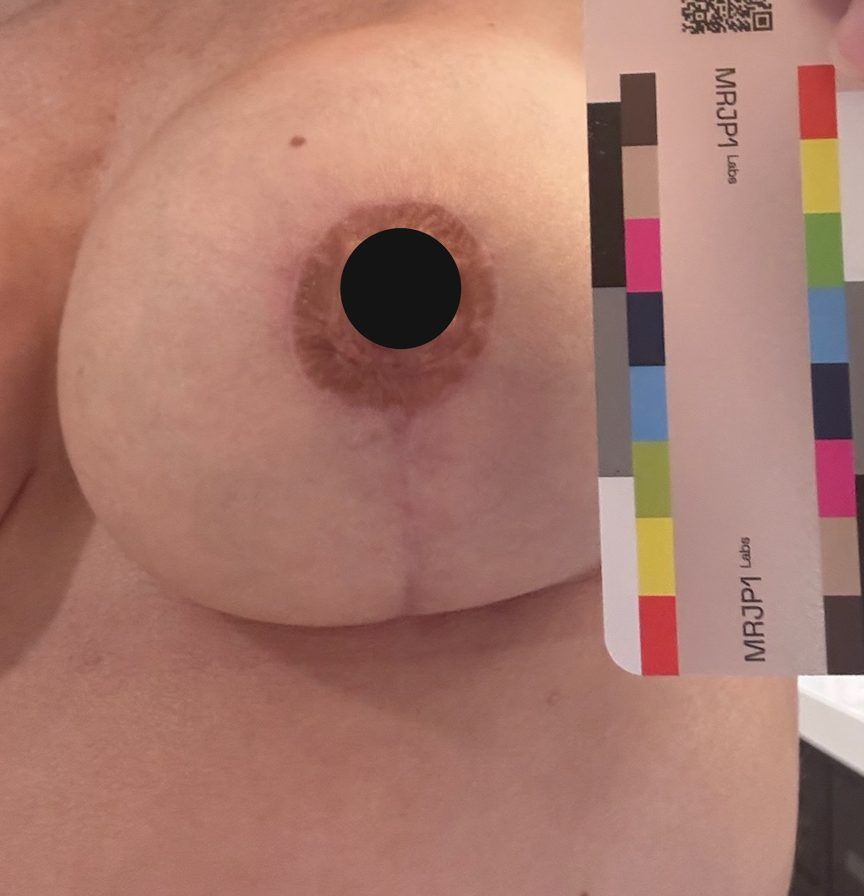 Participant photo, day 88, September 14, 2026: the same scar. The nipple is covered with a black circle for privacy.